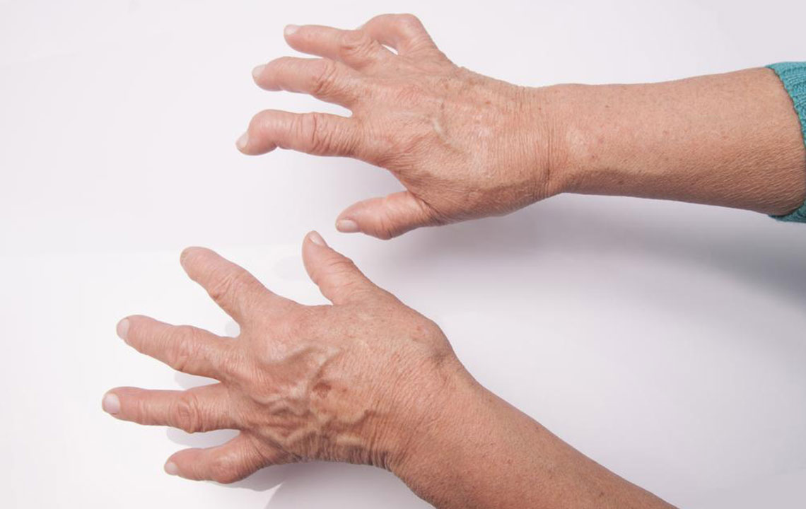 Here’s What You Need to Know About Rheumatoid Arthritis Symptoms