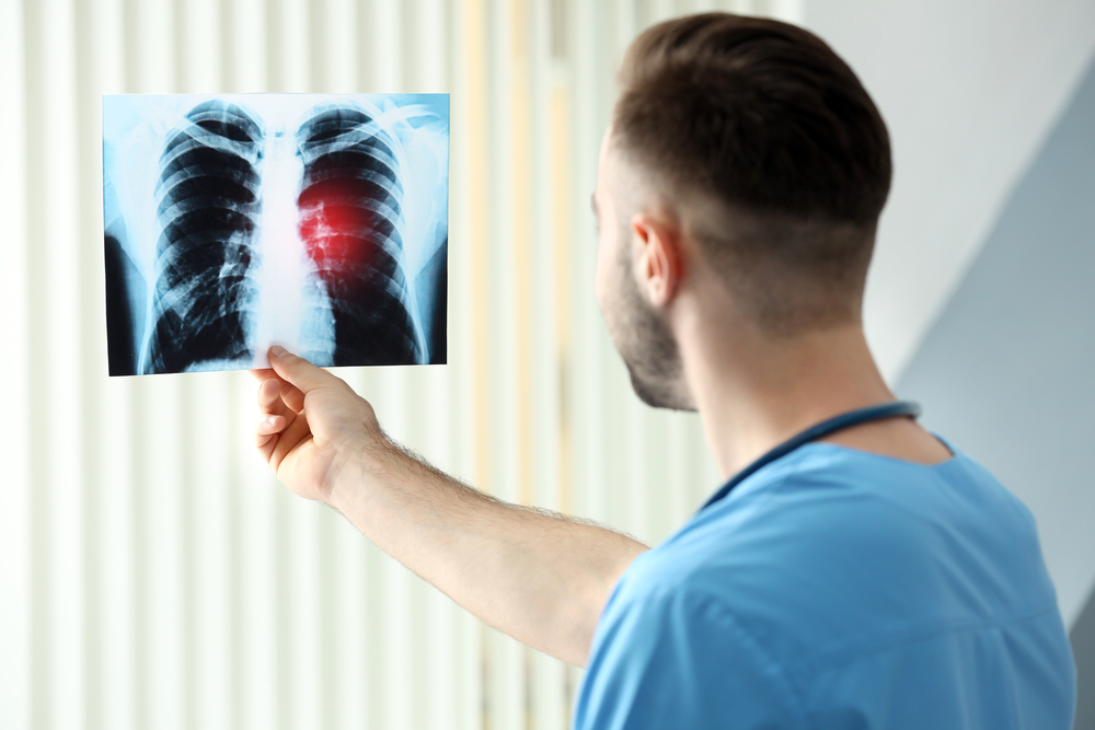 Lung Cancer – Risk Factors, Diagnosis, Symptoms, And Treatment